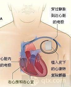 胸腔植入ICD